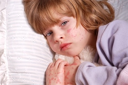 پنج روش اورژانسی برای مقابله با آلرژی در کودکان